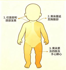 【母婴健康】2026年7月健康教育——新生儿黄疸别慌