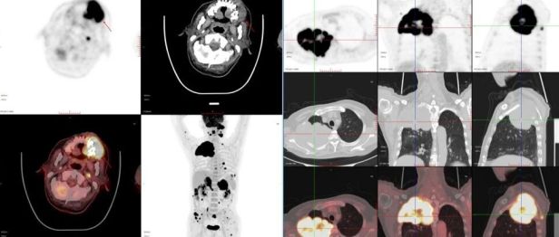 PET/CT 病例分享｜70 岁高龄罕见恶性肿瘤，一站式全身显像厘清复杂病情