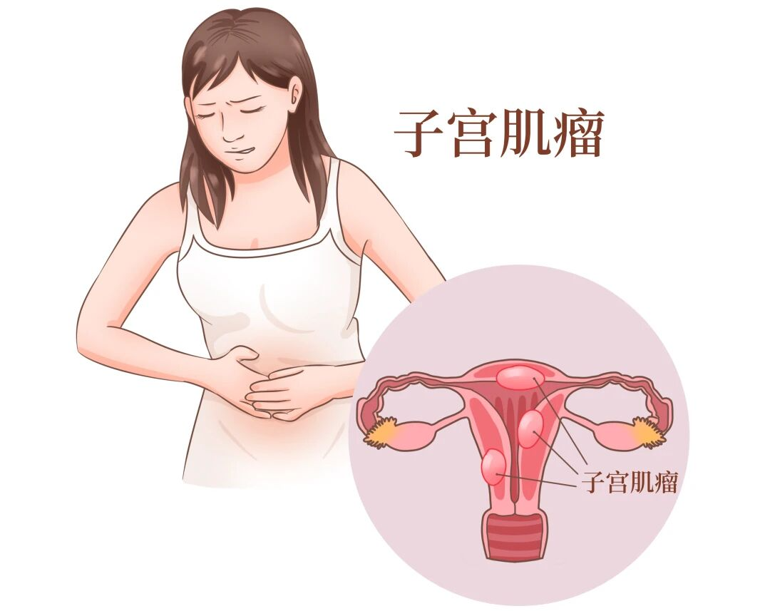 大腿仅一个针眼,怎么悄咪咪 “消灭” 肌瘤?