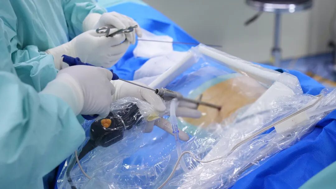 站不得、走不远？67 岁阿姨腰椎间盘突出苦不堪言，台心医院吴建斌教授微创内镜精准「解压」