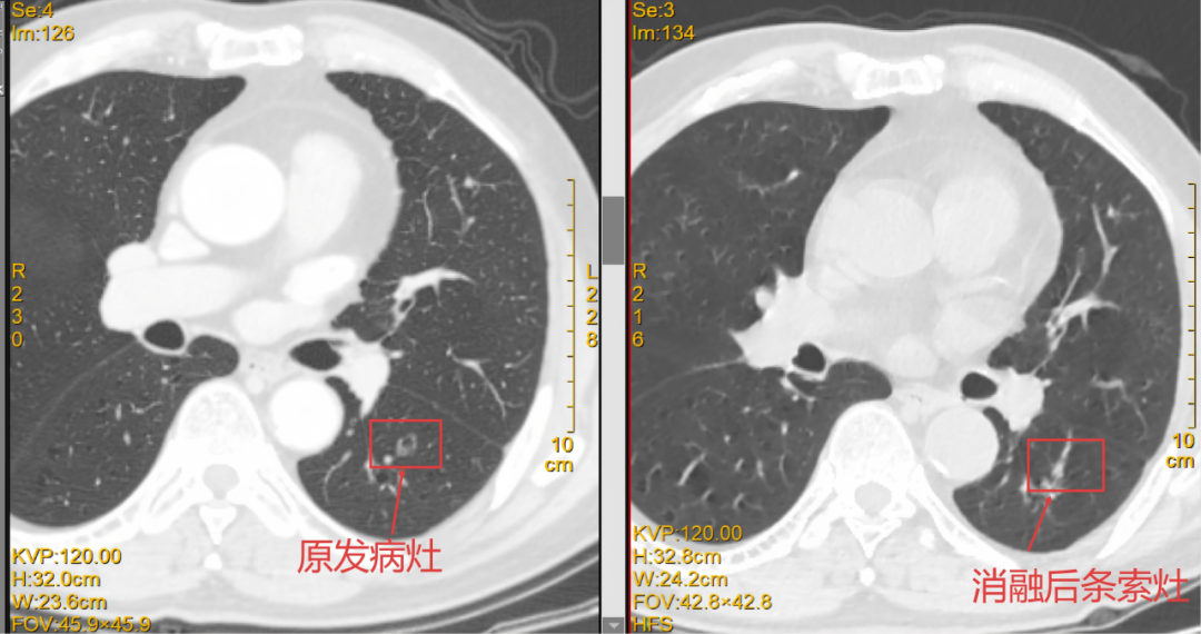 一根细针“精准出击”!桂医大一附院为肺结节患者提供微创治疗新选择