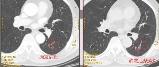 一根细针“精准出击”！桂医大一附院为肺结节患者提供微创治疗新选择