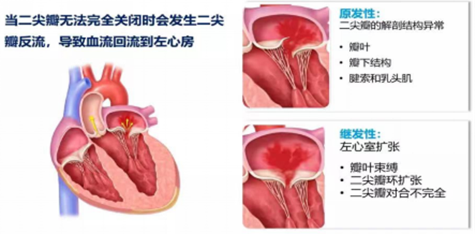 “心”标准,新起点!广西医科大一附院获批首家经导管二尖瓣钳夹术(MitraClip)全国技术培训卓越中心(COE)