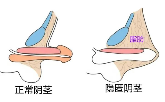 健康科普 | 暑假带娃割包皮?先等等!有一种情况千万别“一刀切”