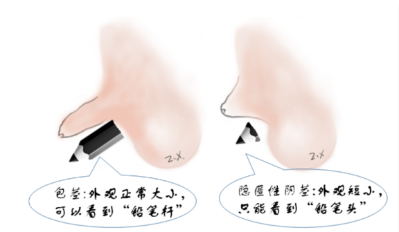健康科普 | 暑假带娃割包皮?先等等!有一种情况千万别“一刀切”