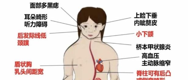 【协作组科普】女孩长得慢、不来月经？警惕特纳综合征