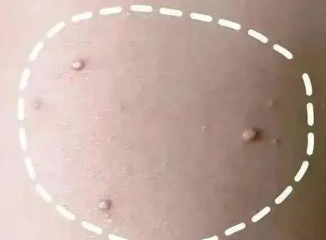 近期常见！不痛不痒的小疙瘩，竟是高传染病毒，别抠