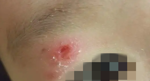 近期常见!不痛不痒的小疙瘩,竟是高传染病毒,别抠