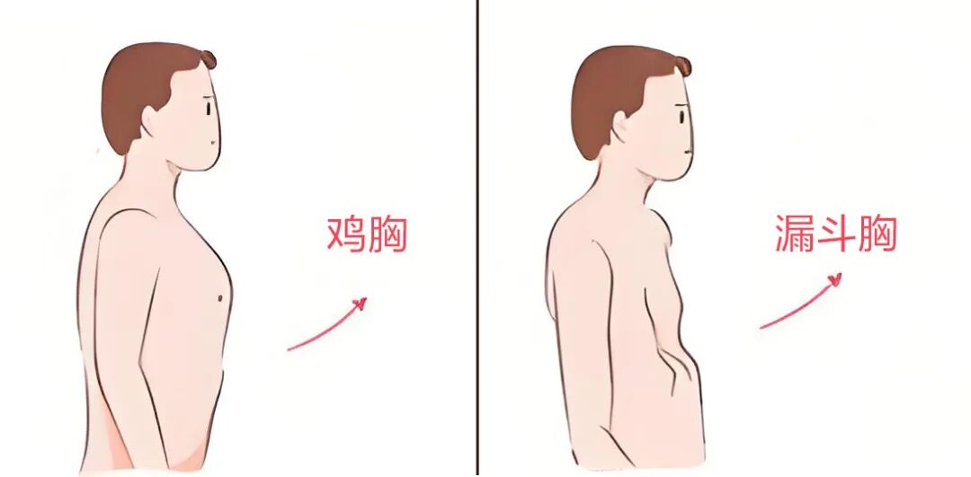 鸡胸漏斗胸不是缺钙!