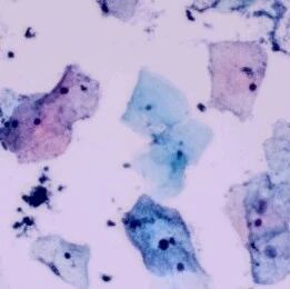 别慌！TCT提示细菌感染≠癌变｜燕达医院病理科一文说清楚