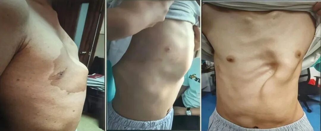 鸡胸漏斗胸不是缺钙!