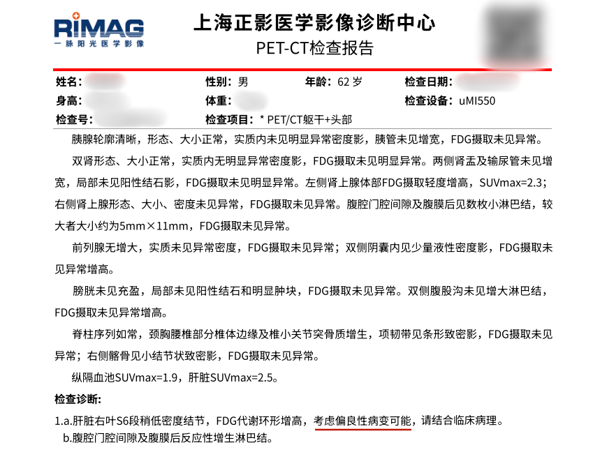 【案例分享】一例肝结节从“疑癌”到“良性”背后的精准抉择