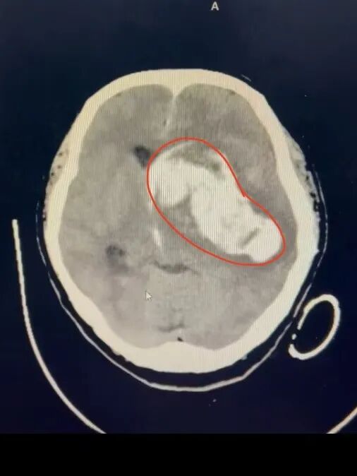 生死竞速,连夜闯关!南京江北医院多学科联手,挽救脑疝危重患者
