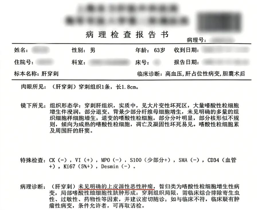 【案例分享】一例肝结节从“疑癌”到“良性”背后的精准抉择