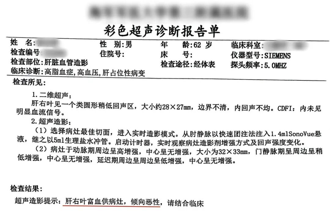【案例分享】一例肝结节从“疑癌”到“良性”背后的精准抉择