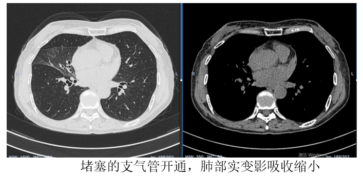 常年吃饭呛咳竟堵死半边肺!瑞康医生内镜抢救化解致命并发症