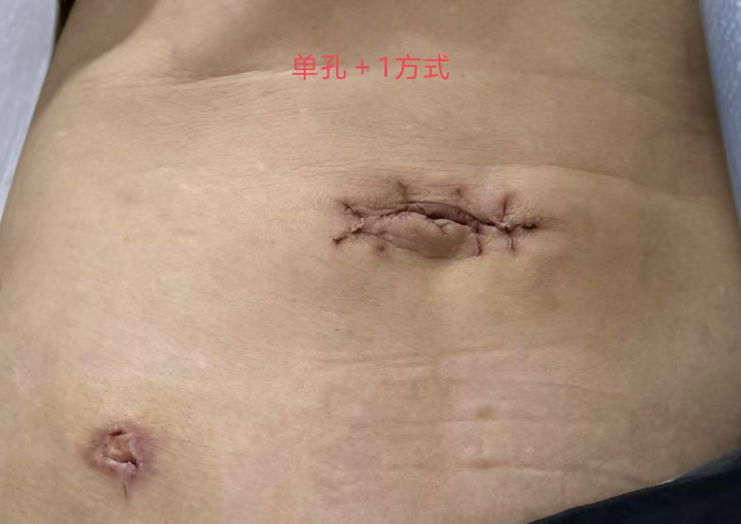 【技术突破】微创技术新突破——重庆大学黔江医院胃肠甲乳外科成功开展单孔+1腹腔镜下直肠癌根治术(SILS+1)