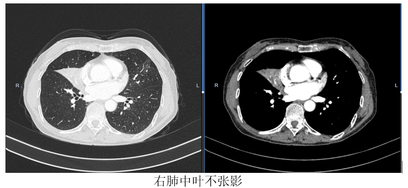 常年吃饭呛咳竟堵死半边肺!瑞康医生内镜抢救化解致命并发症