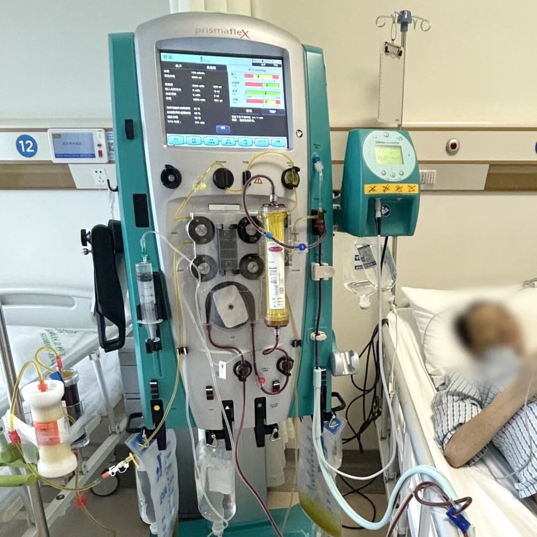 “人工肝”:为肝衰竭患者开辟生命通道