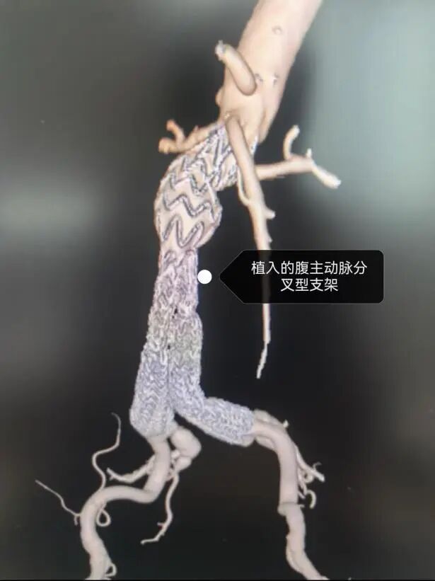 90岁老人腹主动脉瘤大如拳头,濒临破裂!桂林医生1.5小时“拆弹”成功