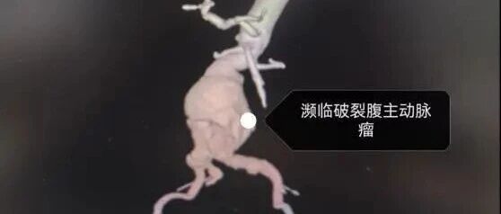 90岁老人腹主动脉瘤大如拳头，濒临破裂！桂林医生1.5小时“拆弹”成功