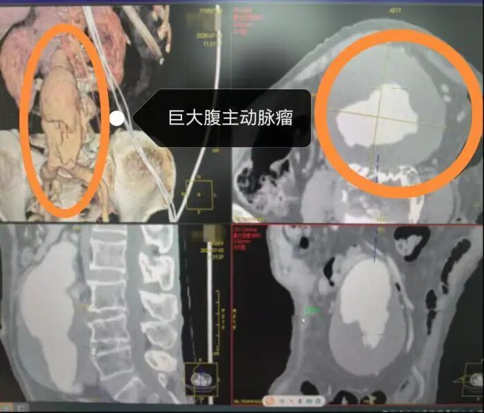 90岁老人腹主动脉瘤大如拳头,濒临破裂!桂林医生1.5小时“拆弹”成功