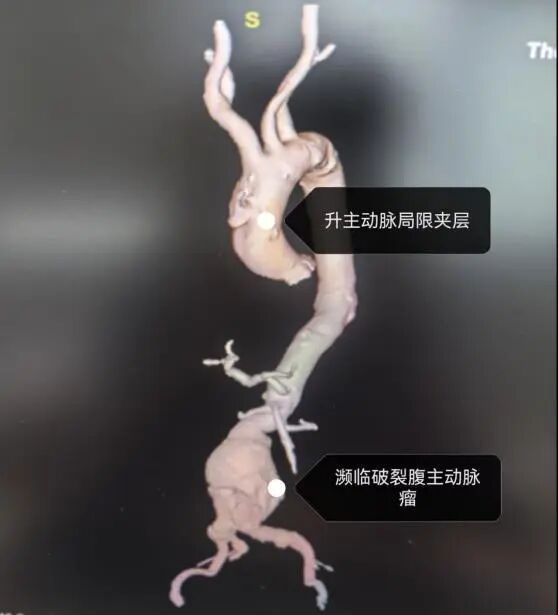 90岁老人腹主动脉瘤大如拳头,濒临破裂!桂林医生1.5小时“拆弹”成功