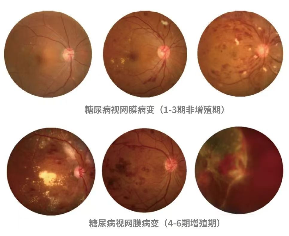 【二附院医生说】眼睛里的隐秘危机：糖尿病视网膜病变