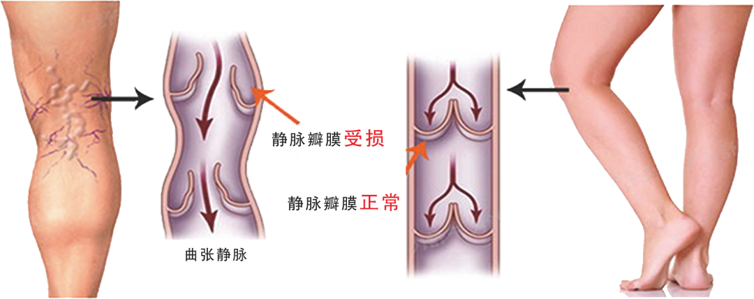 静脉曲张有必要做手术吗?