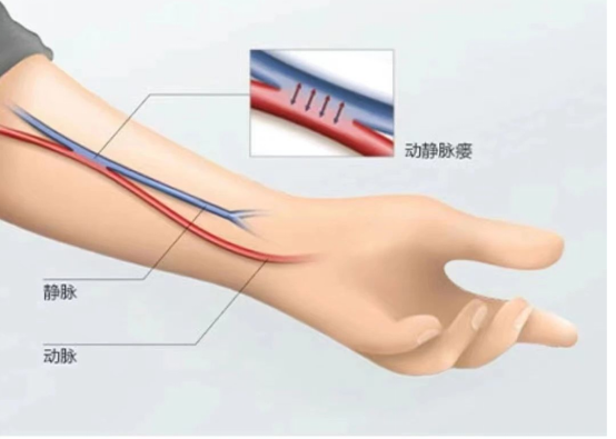 守护透析“生命线”——动静脉内瘘
