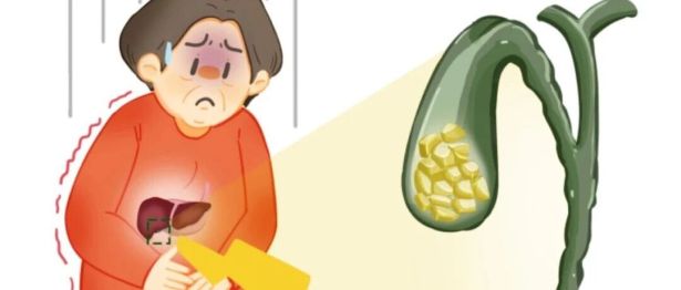 “脐”迹取石，胆宁无痕——河科大二附院成功完成院内首例单孔腹腔镜胆囊切除术