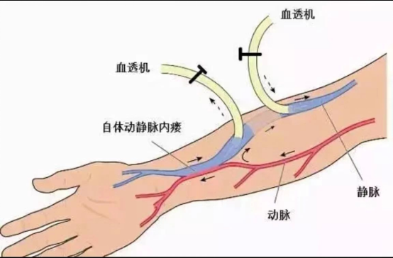 守护透析“生命线”——动静脉内瘘