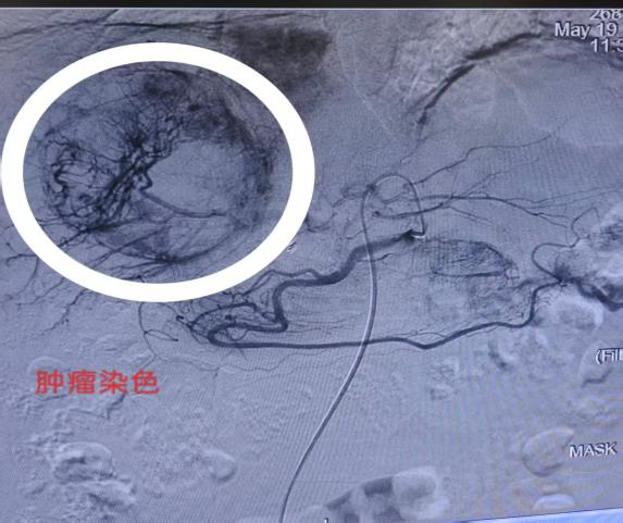 【人医科普】不开刀治肝癌，揭秘TACE肝动脉化疗栓塞术