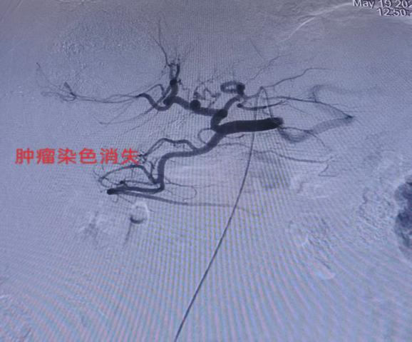 【人医科普】不开刀治肝癌,揭秘TACE肝动脉化疗栓塞术