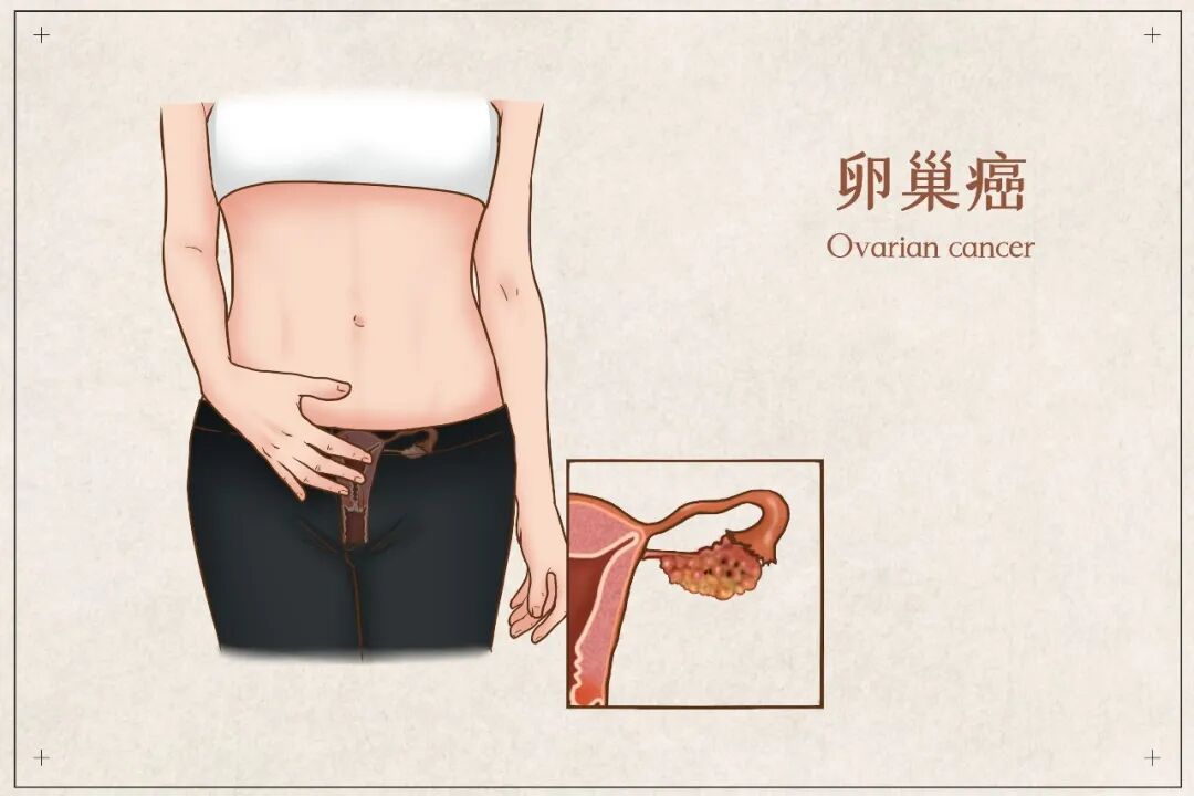 奥拉帕利:为妇科肿瘤患者带来精准治疗新希望