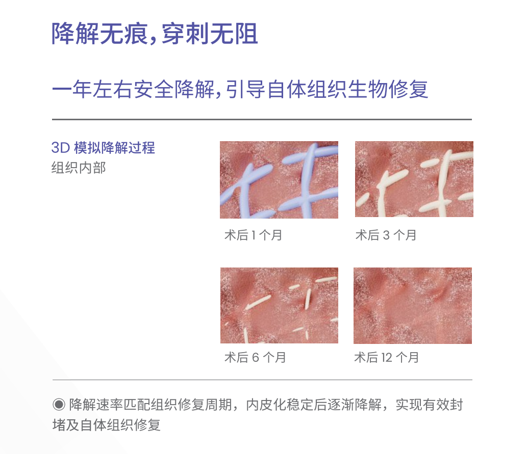 介入无植入，微创无残留！西安市第三医院心内四病区成功开展生物可降解卵圆孔未闭封堵新技术