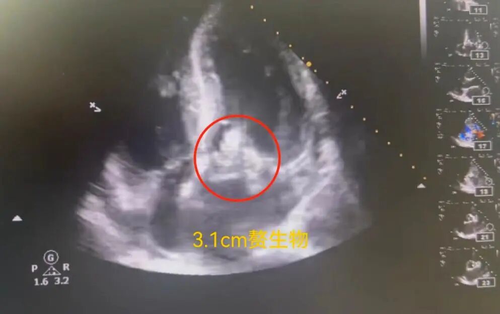 心脏“阀门”被病菌啃噬!我院多学科联合成功救治重症心内膜炎患者