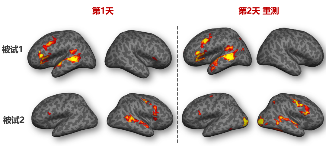 帕金森病、阿尔茨海默病、抑郁症等,常规核磁看不出问题?请关注这张「大脑功能地图」