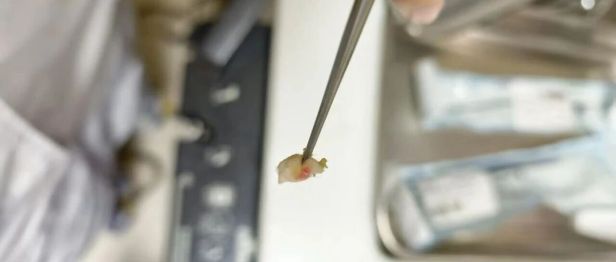 50岁女子耳朵里“焊”了团棉花？取出时沾满血迹，医生：这个习惯，赶紧“戒”！