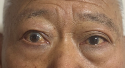 突眼不只是“颜值问题”！这种眼病，拖久了可能伤视力