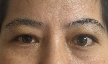 突眼不只是“颜值问题”！这种眼病，拖久了可能伤视力