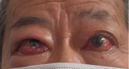 突眼不只是“颜值问题”！这种眼病，拖久了可能伤视力