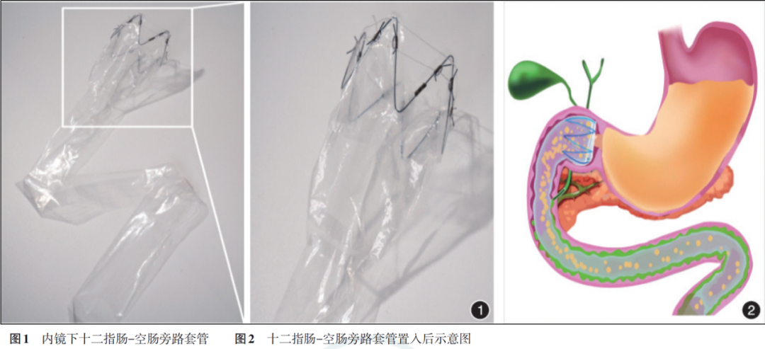代谢综合征控制不住？这里有个新思路