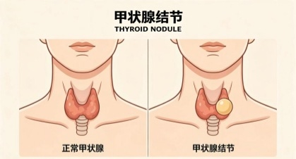 告别焦虑,护好脖子上的“生命蝴蝶”
