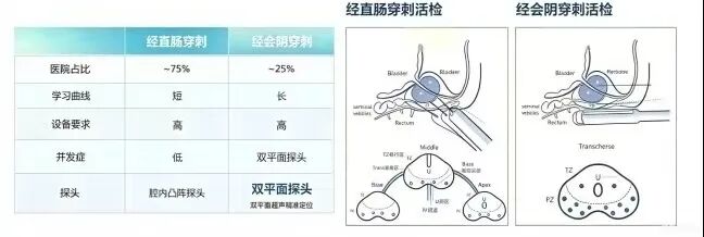 精准穿刺 安全护航 —— 河北一洲肿瘤医院超声医学科顺利开展高难度经会阴前列腺穿刺活检术
