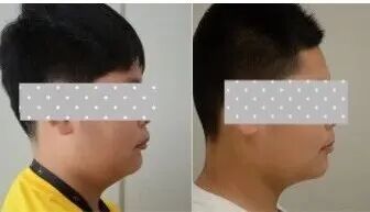 下巴后缩不止是不好看!真正的核心问题是「咬合错位」