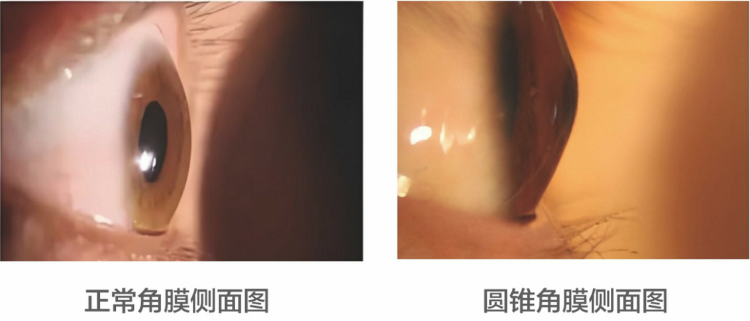 视力突然断崖式下降？警惕会“变形”的圆锥角膜！年轻人高发