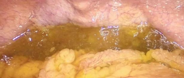 女子腹痛忍了十几年！谁知腹腔长满果冻样肿瘤