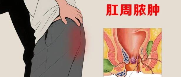台风天“菊部”告急？别把脓肿当痔疮！