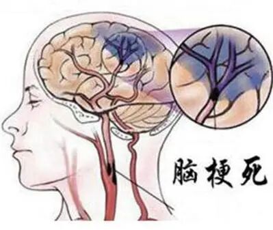 从“时间窗”到“组织窗”！突破17小时救治极限，河科大二附院成功救治超窗急性脑梗死患者